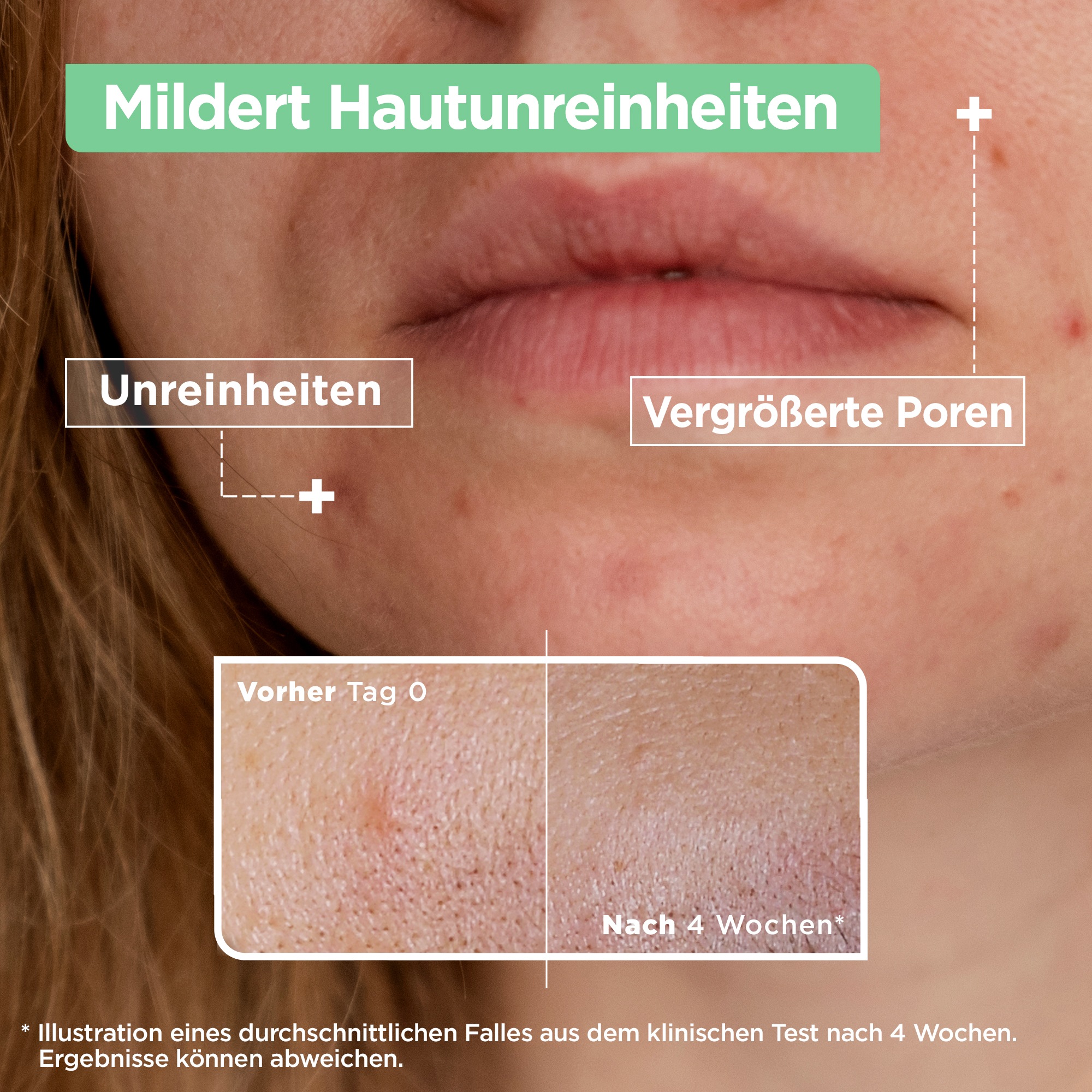 Mixa Gesichtsserum »Mixa Anti-Unreinheiten Serum«, mit hoher Wirksamkeit