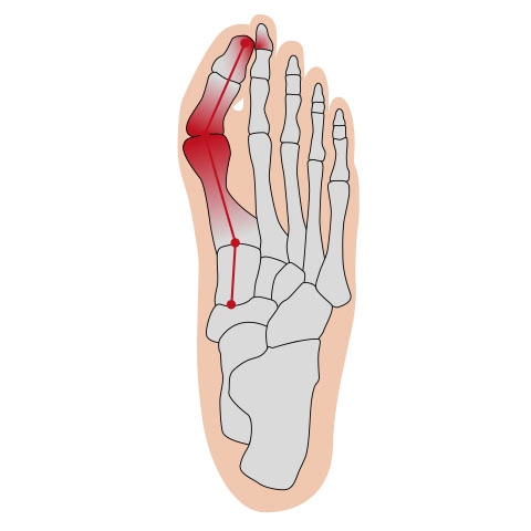 Fußgut Hallux-Bandage »Softkissen«