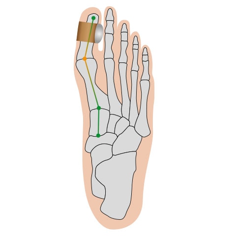 Fußgut Hallux-Bandage »Softkissen mit Fixierband, verhindert Reiben«, Druckentlastung bei Hühneraugen, Schwielen, Entlastung Hallux Valgus
