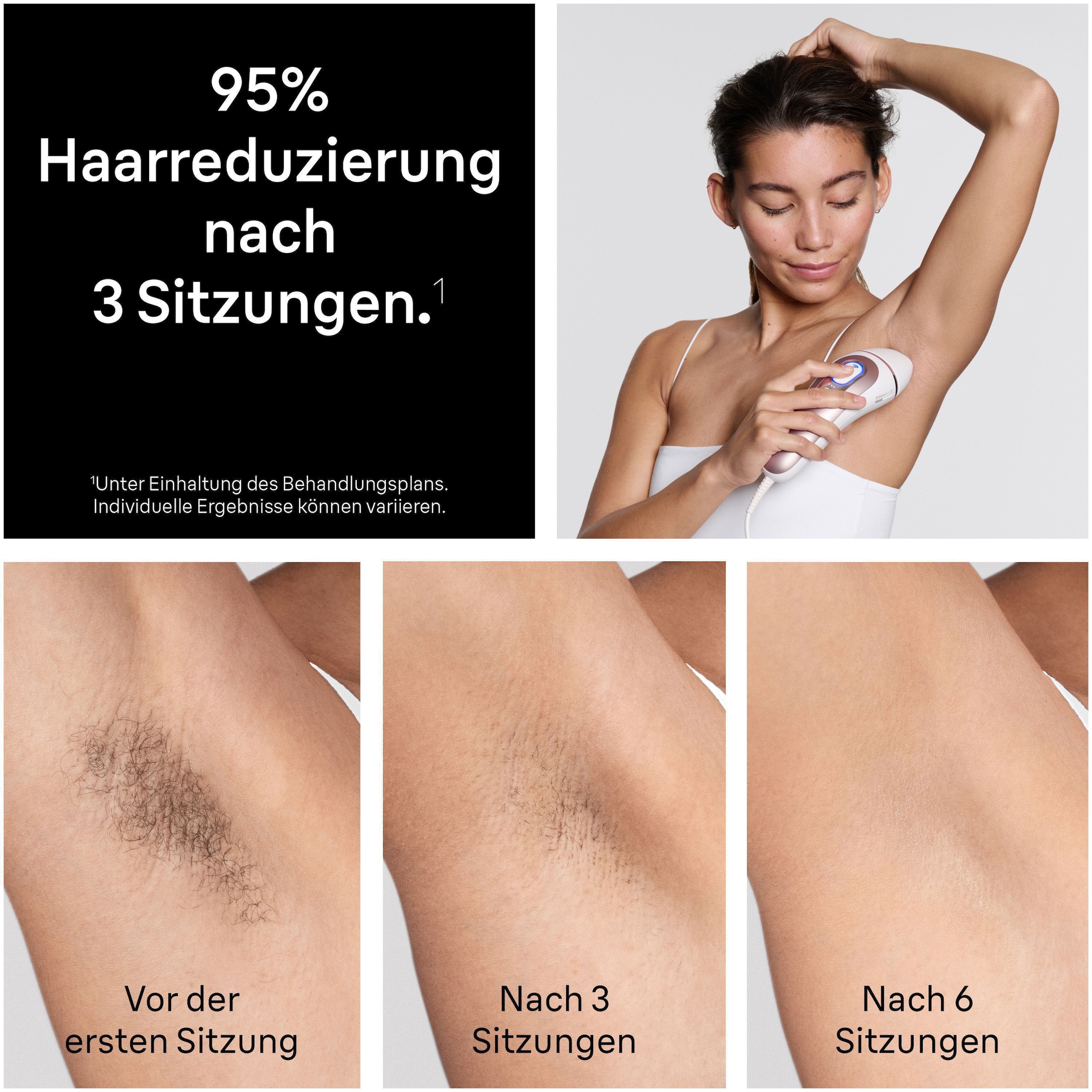 Braun IPL-Haarentferner »Braun Smart IPL Skin i·expert PL7431« 400.000 Lichtimpulse Laser-Haarentfernung für zu Hause, Dauerhafte Haarreduzierung