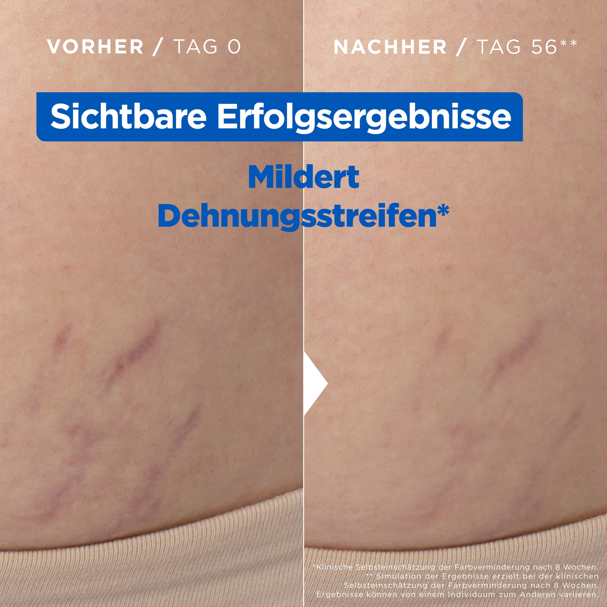 Mixa Körperlotion »Mixa Niacinamide Stretchmark Oil«